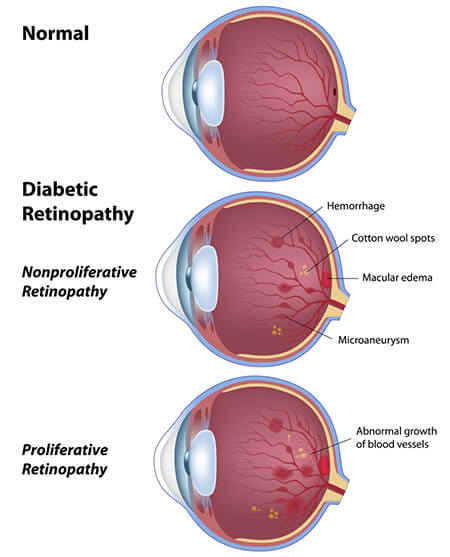 diabetic_retinopathy