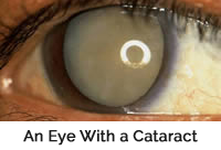 mature_cataract_with-caption